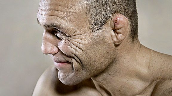 cauliflower ears in martial arts